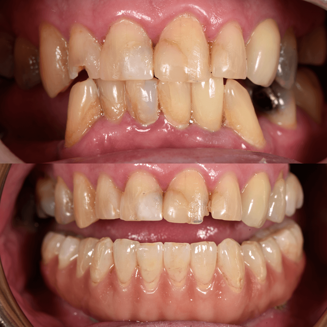 All-on-X Implant