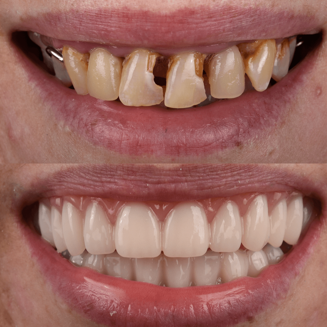 All-on-X Implant