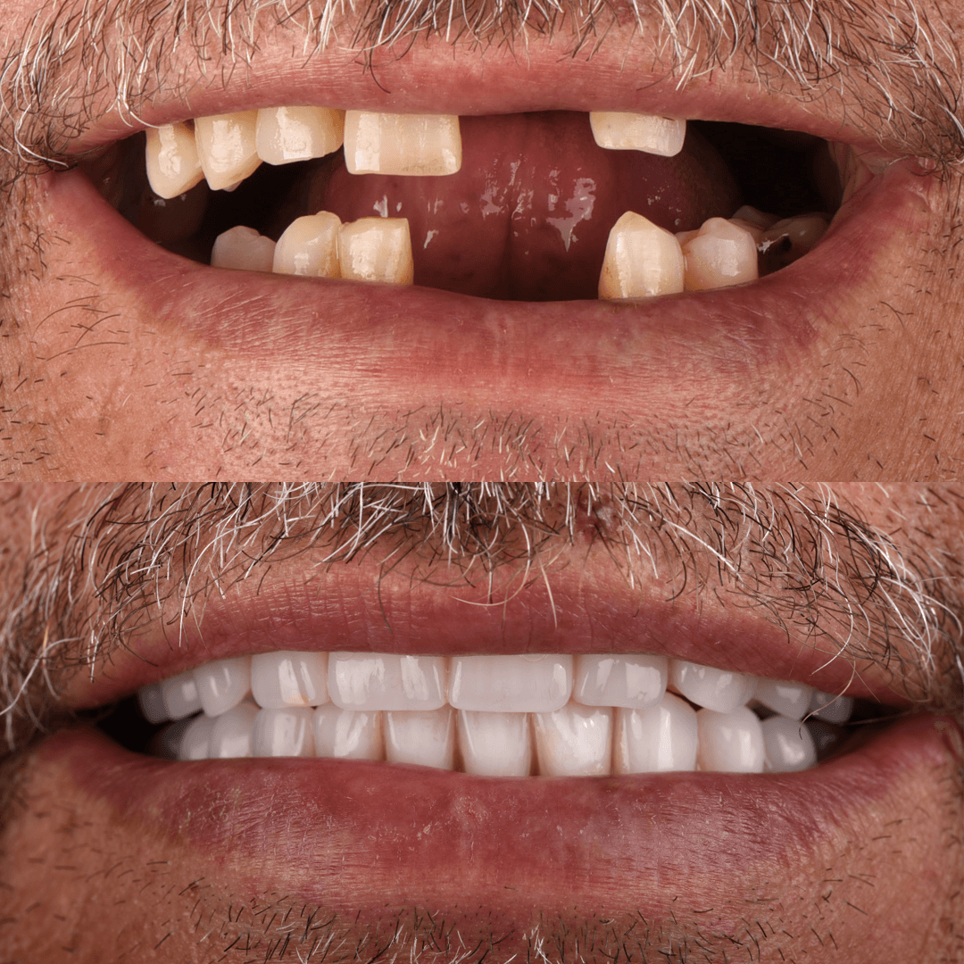 All-on-X Implant