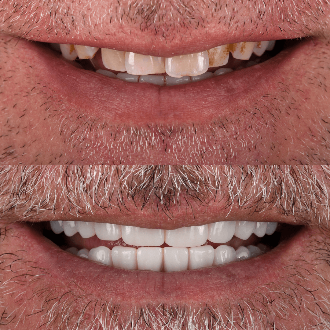 All-on-X Implant
