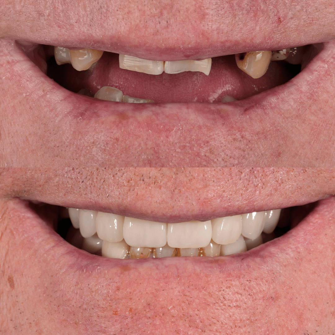 Crowns & Implants