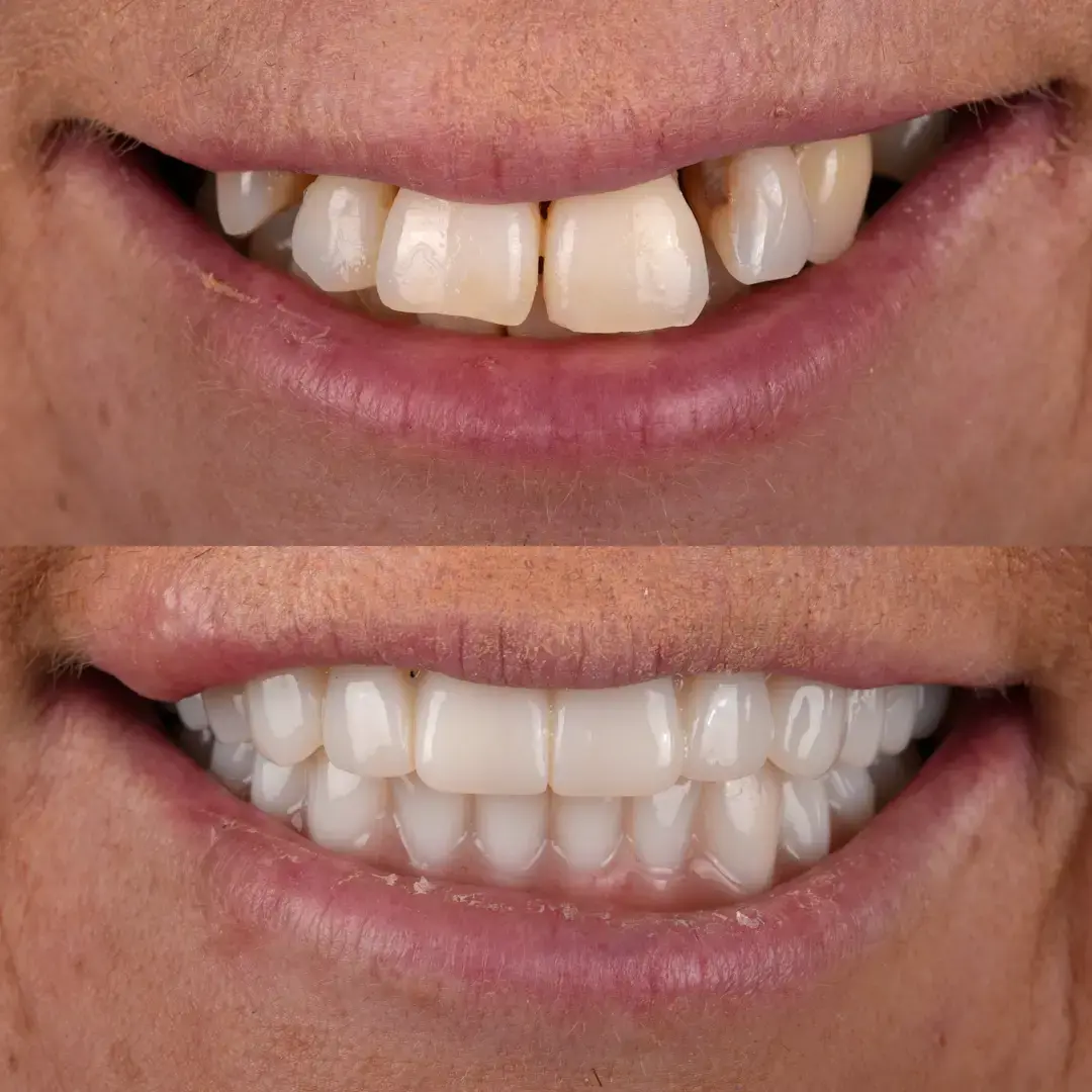 All-on-X Implant