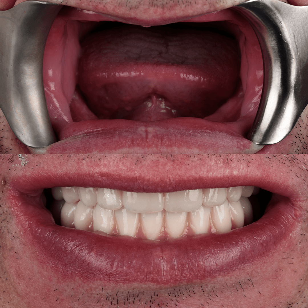 All-on-X Implant