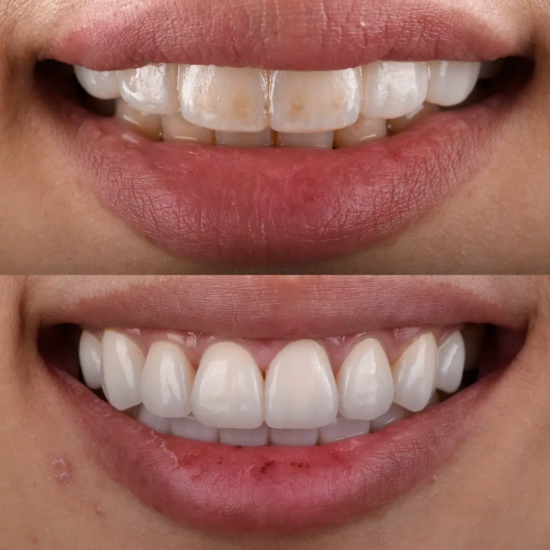 Veneers