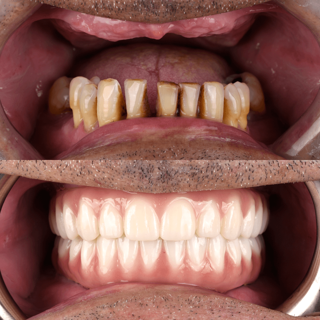 All-on-X Implant