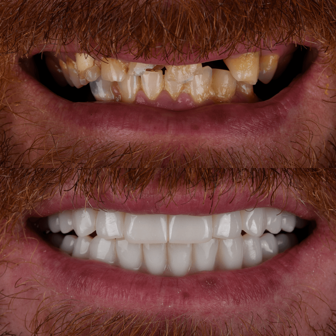 All-on-X Implant