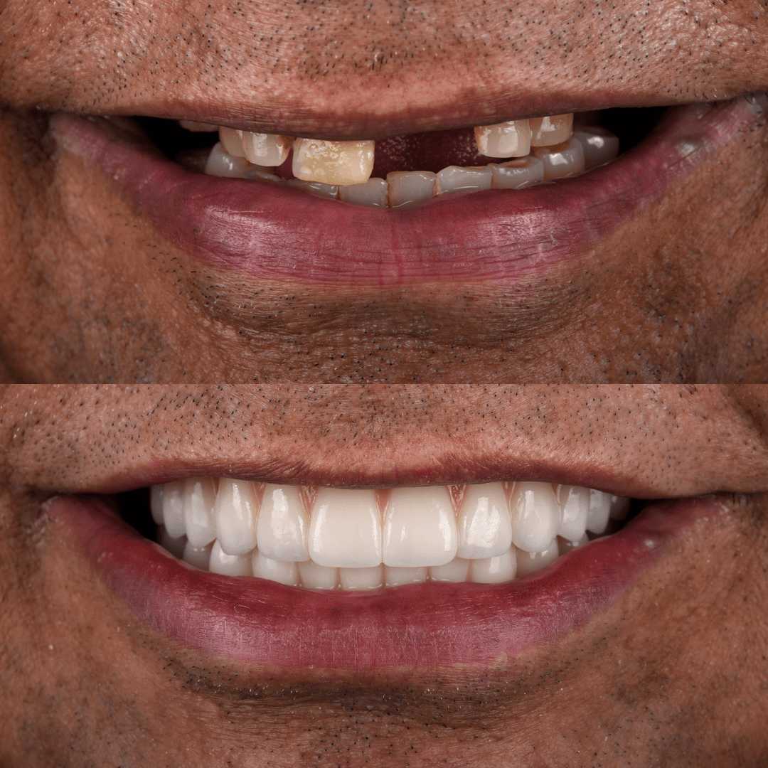 All-on-X Implant