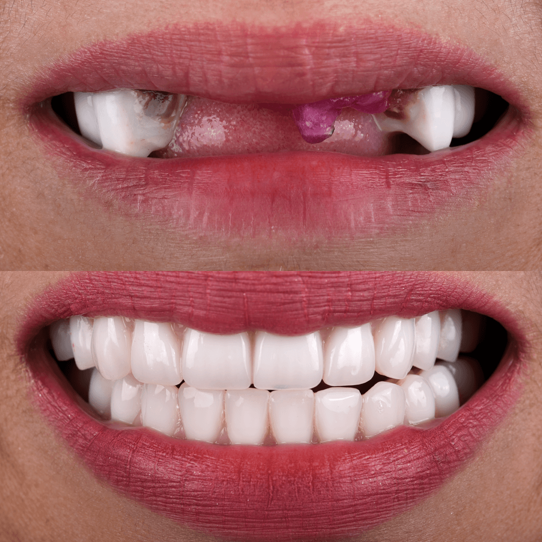All-on-X Implant