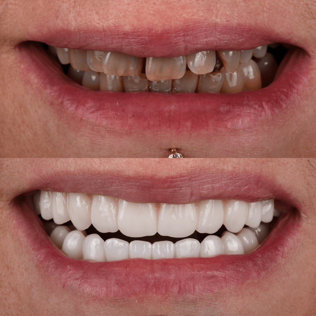 All-on-X Implant