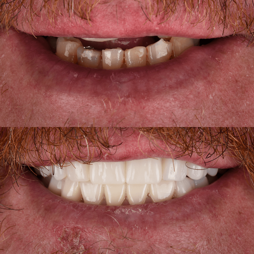 All-on-X Implant