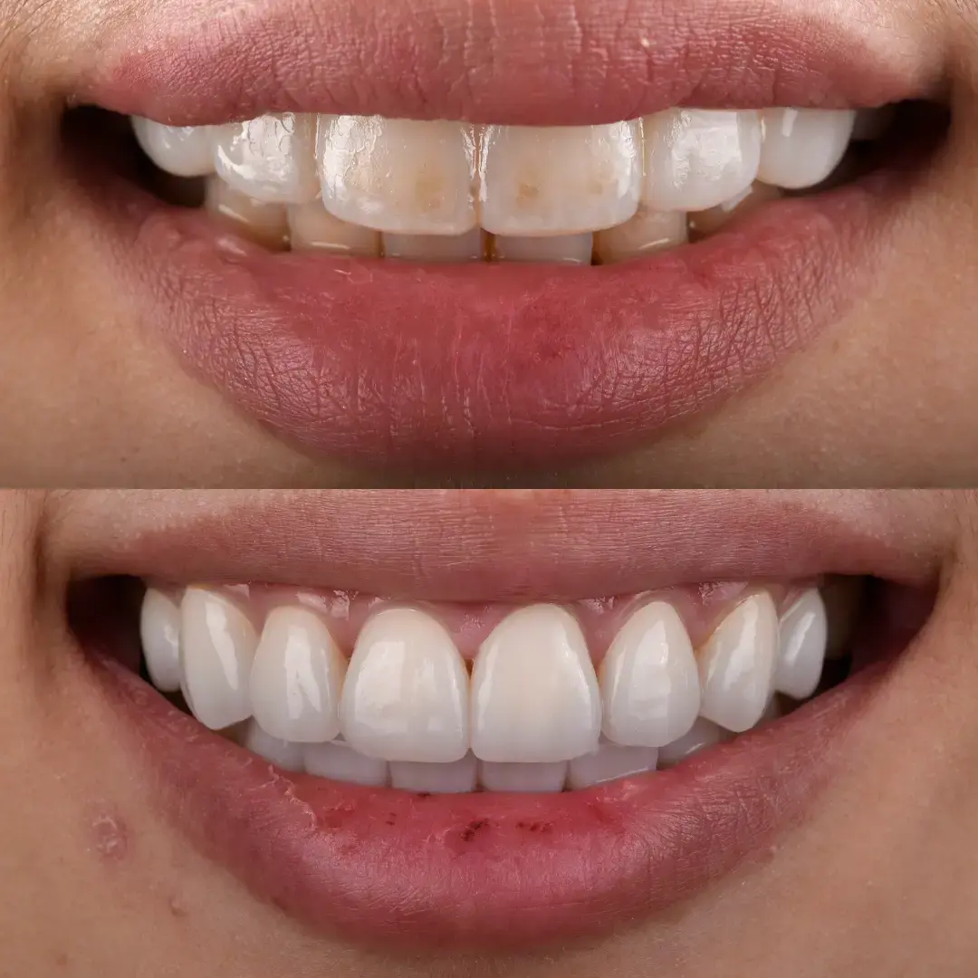 Veneers