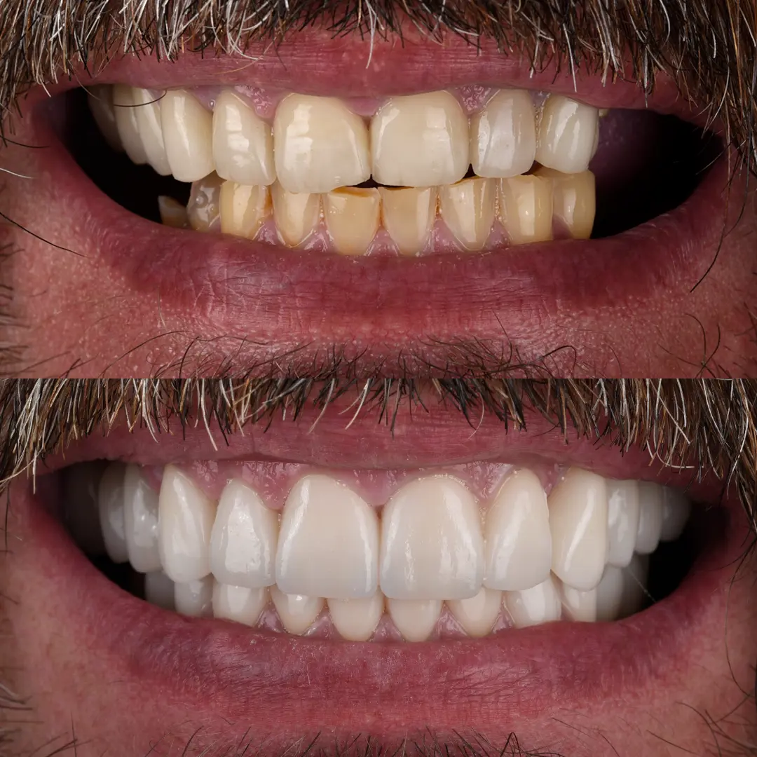 Crowns & Implants
