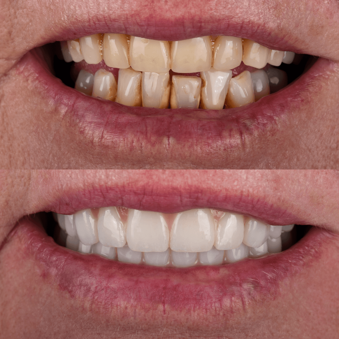 All-on-X Implant