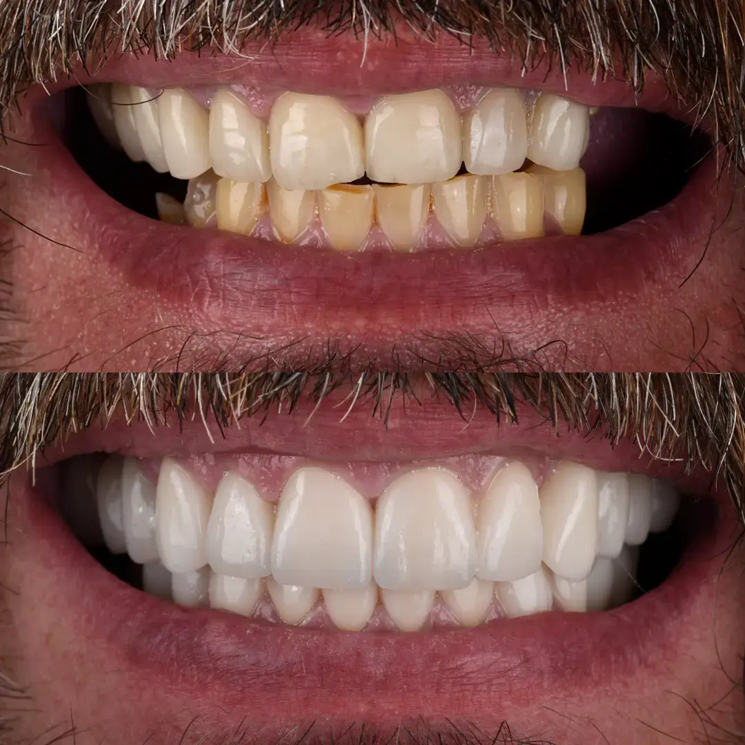 Crowns & Implants