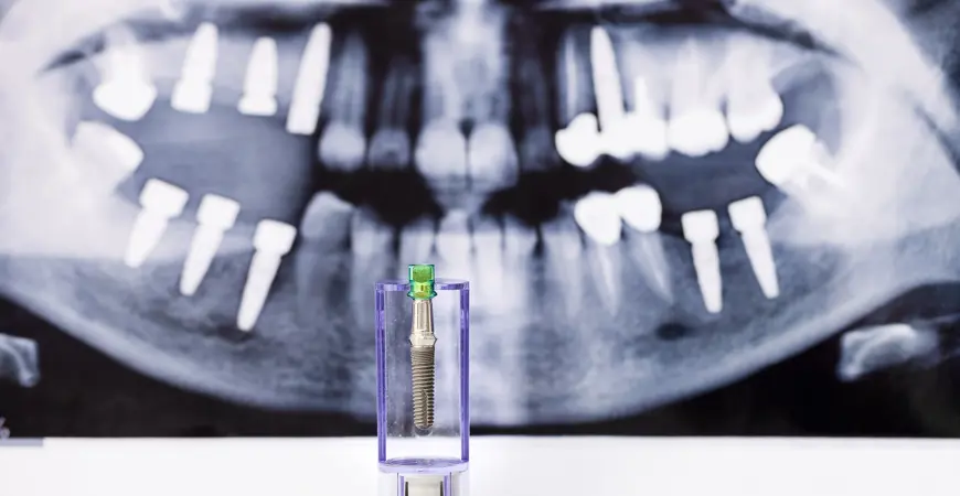 dental-implant-and-x-ray-picture-as-background-2026-01-07-06-35-23-utc.jpg
