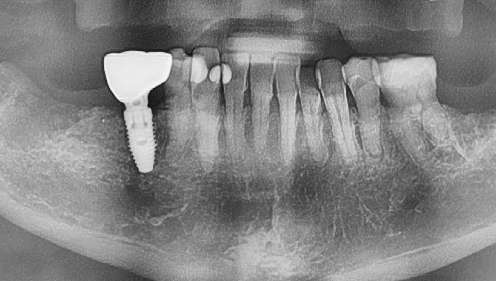 Single Implant.png