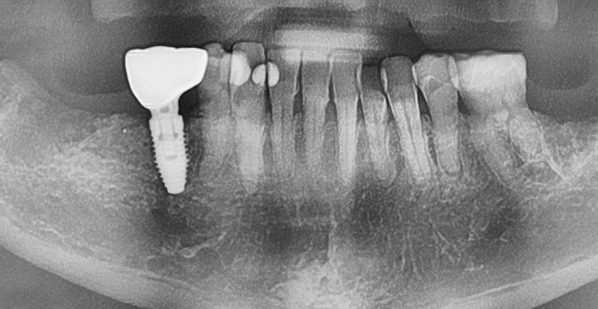 Single Implant.png