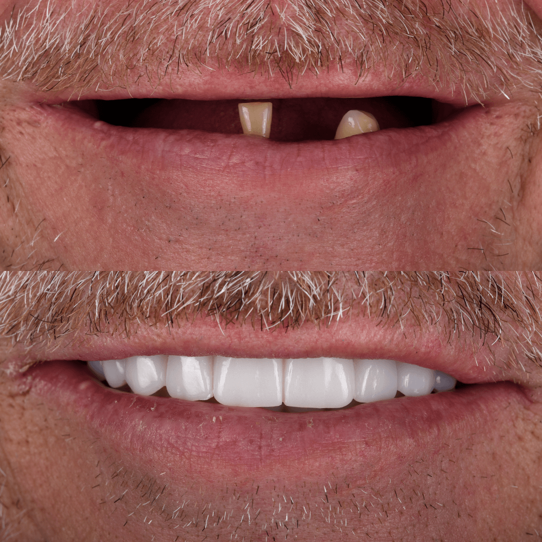 All-on-X Implant