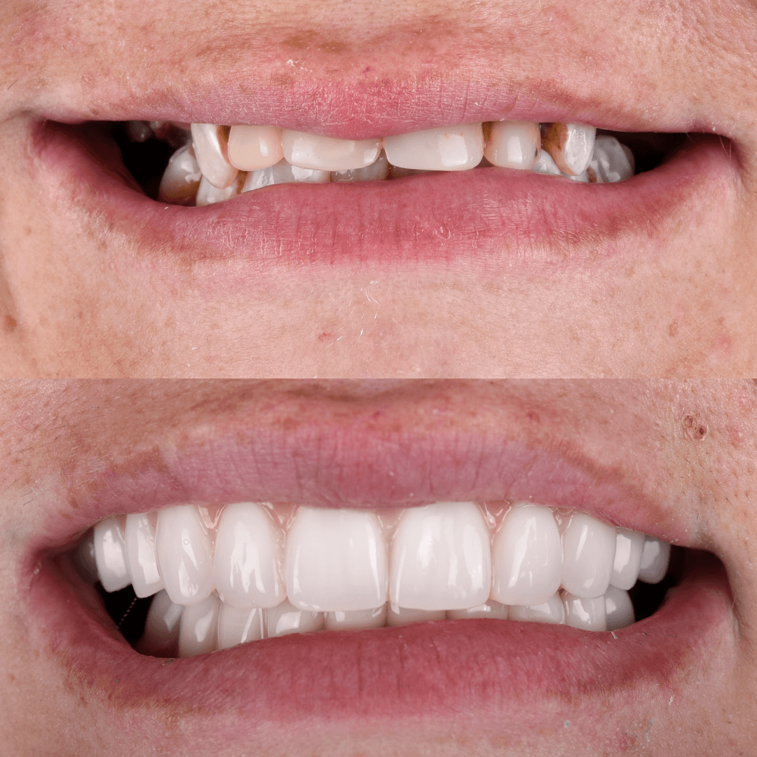 All-on-X Implant