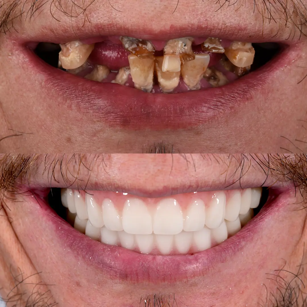 All-on-X Implant