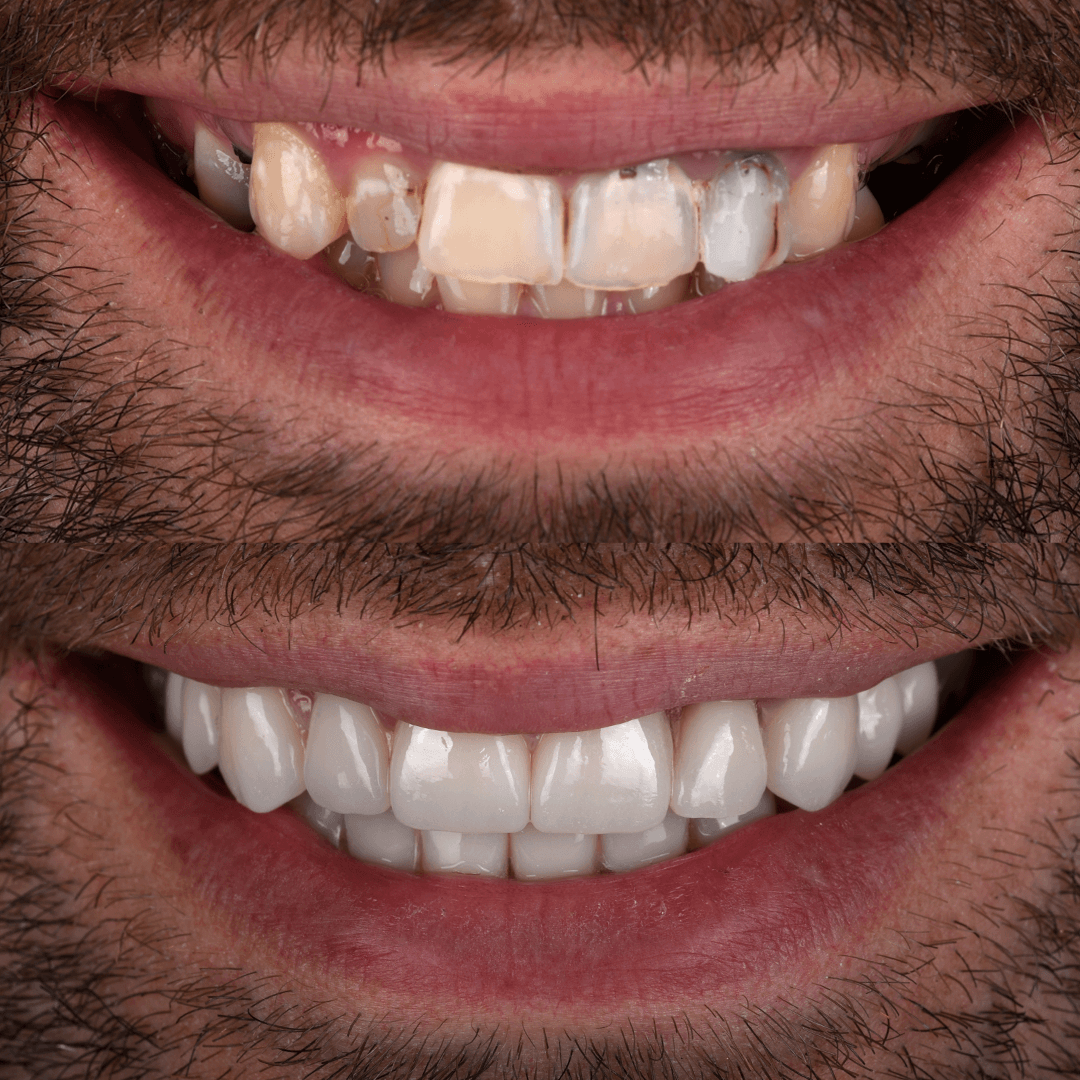 Crowns & Implants