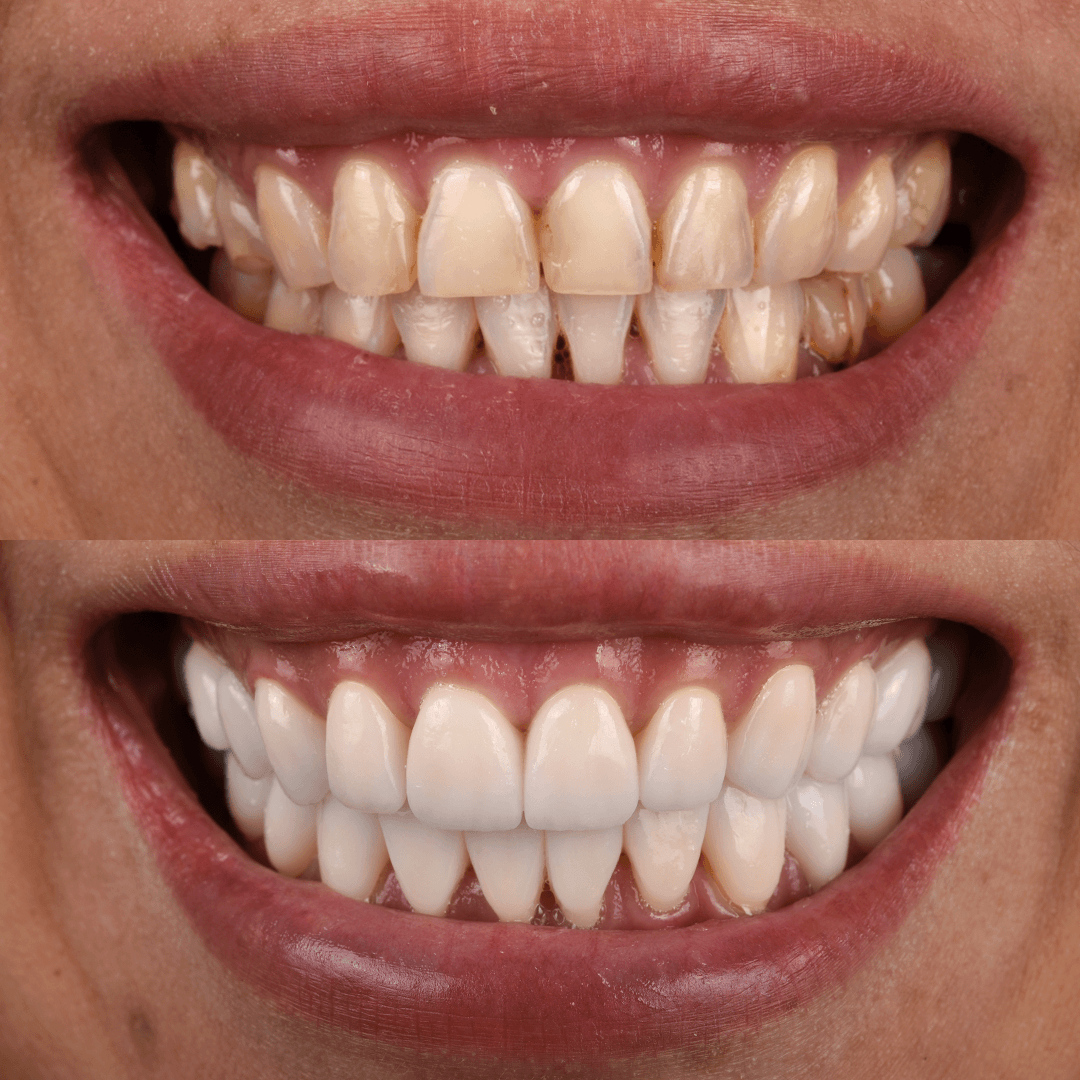 Crowns & Implants