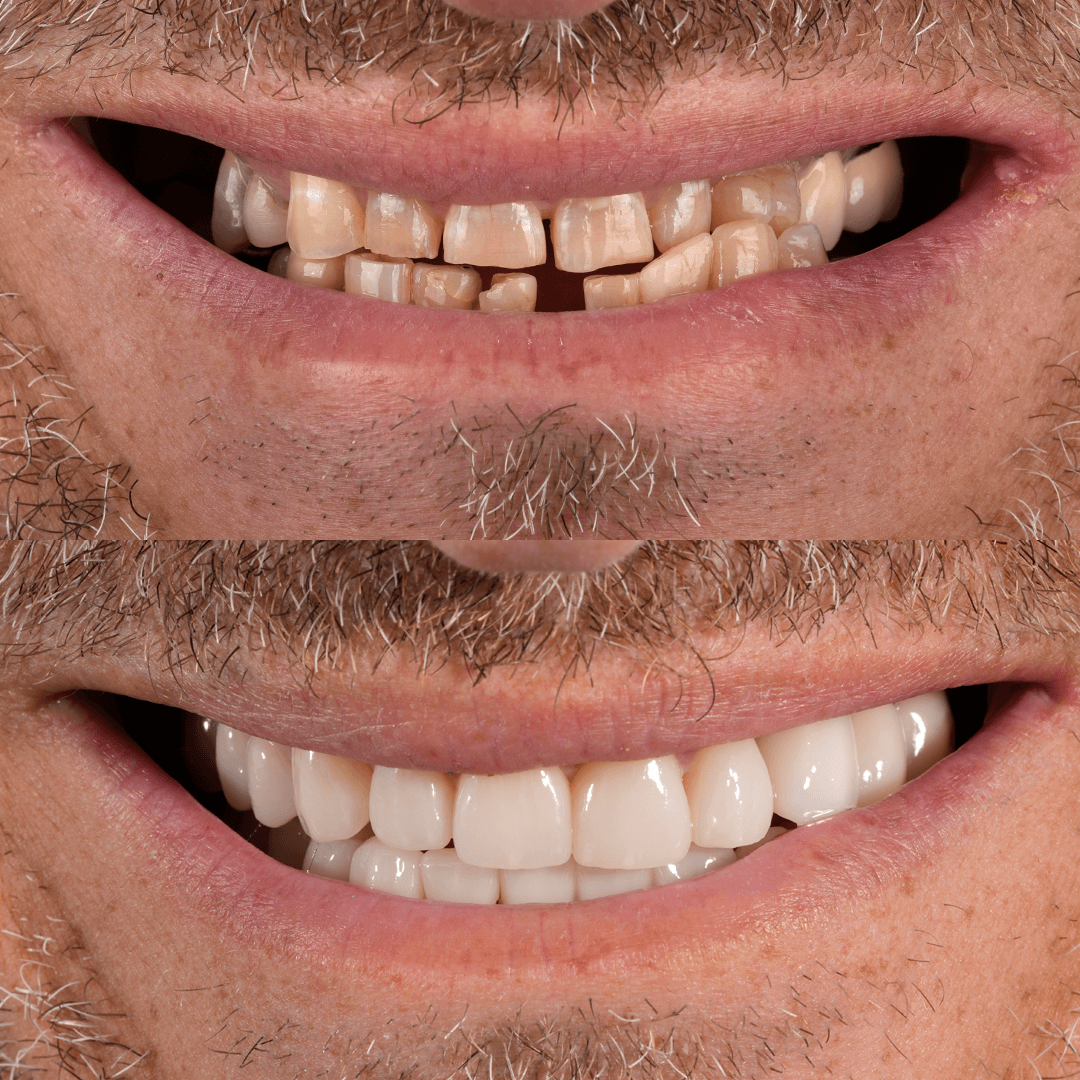 Crowns & Implants