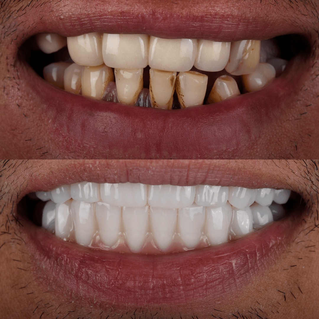All-on-X Implant