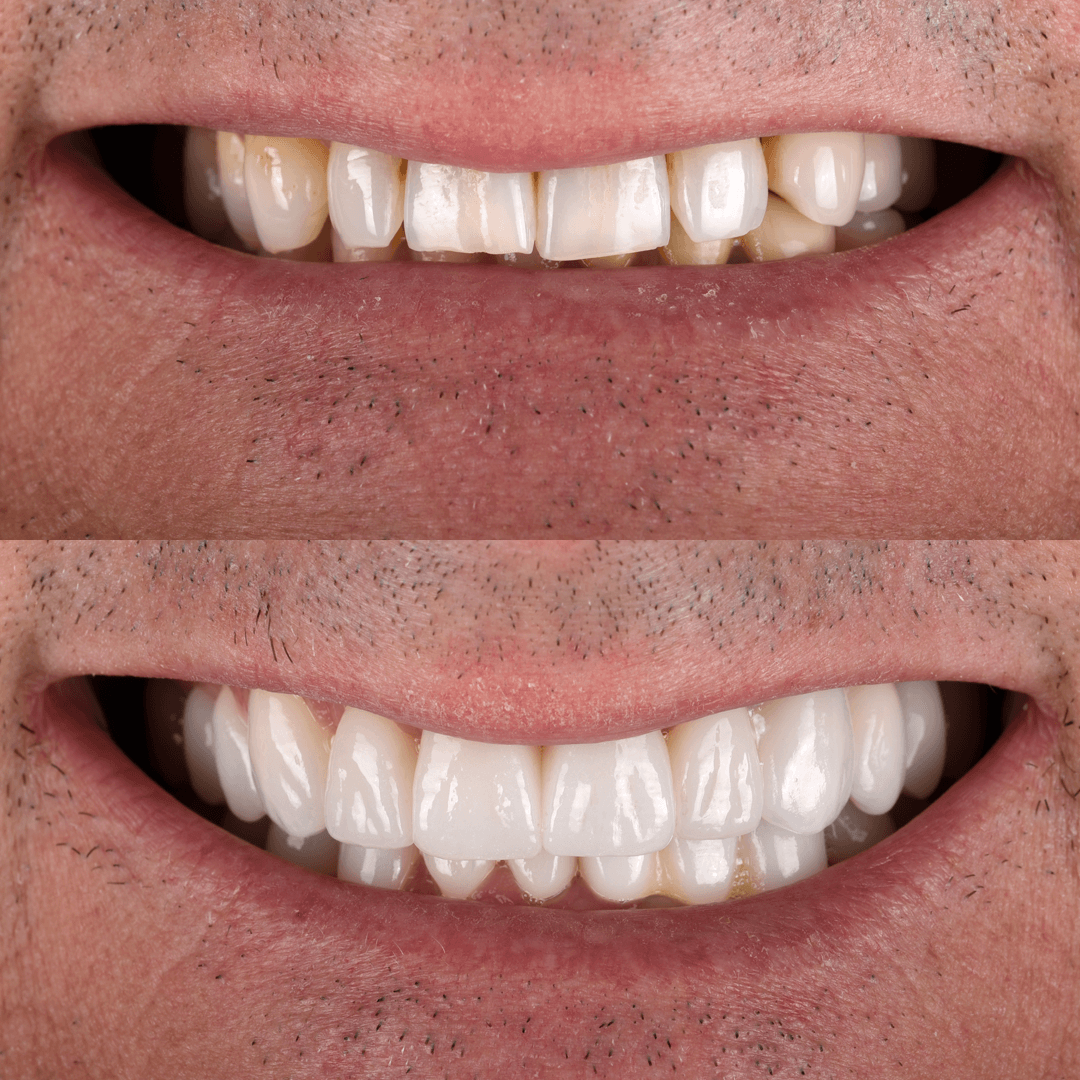 Crowns & Implants