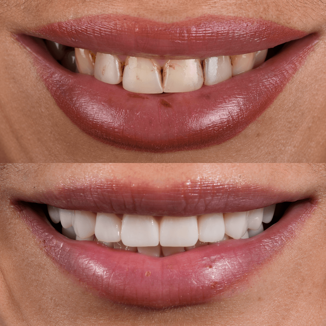 Crowns & Implants