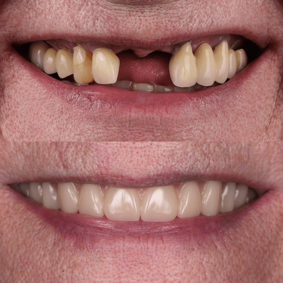 All-on-X Implant