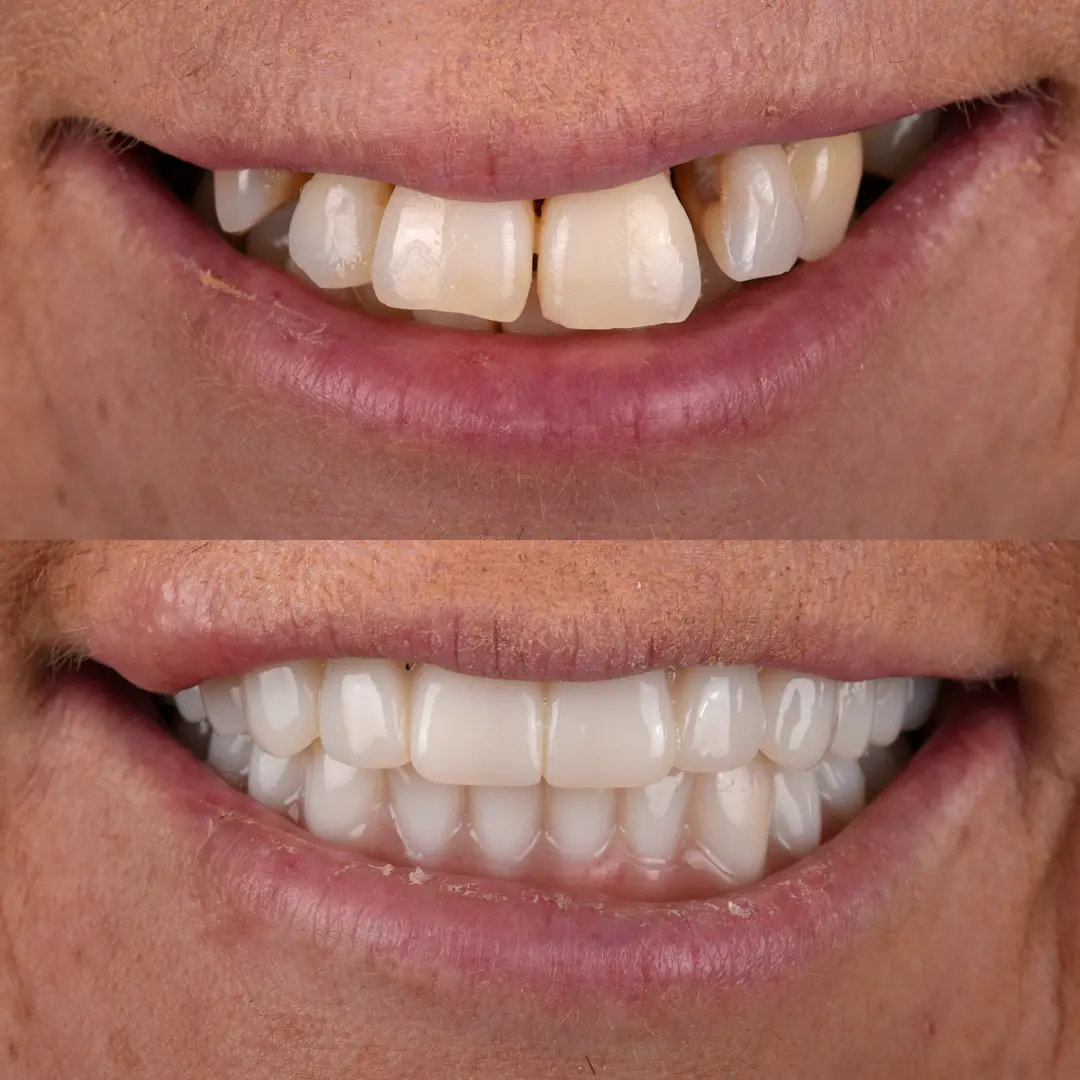 All-on-X Implant