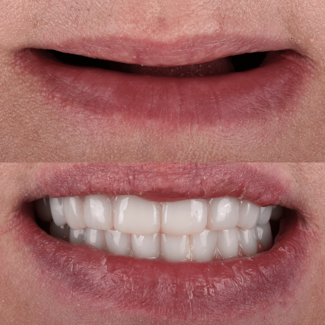 All-on-X Implant