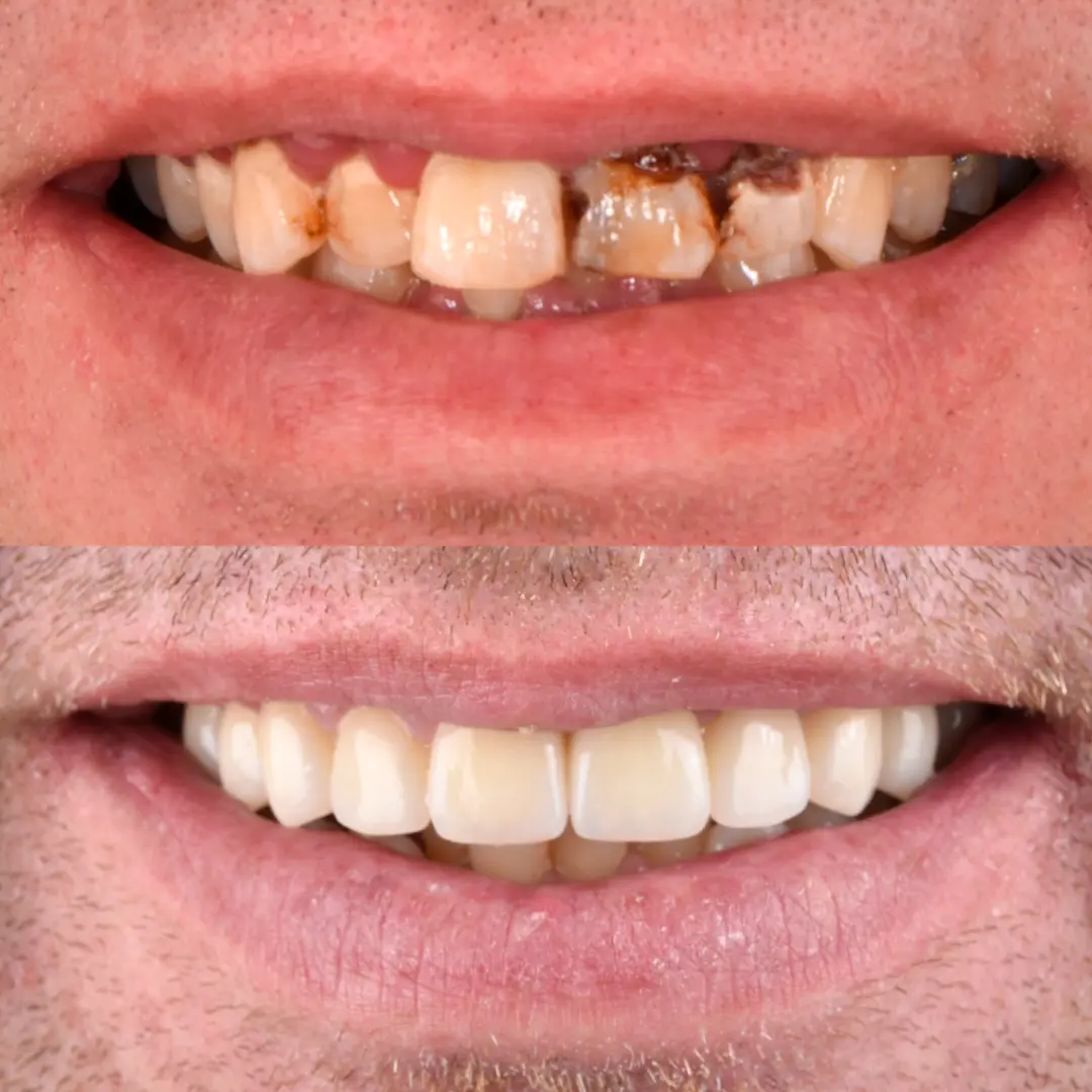 Crowns & Implants