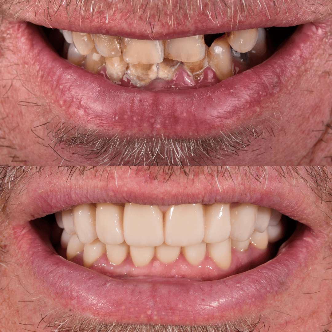 Crowns & Implants
