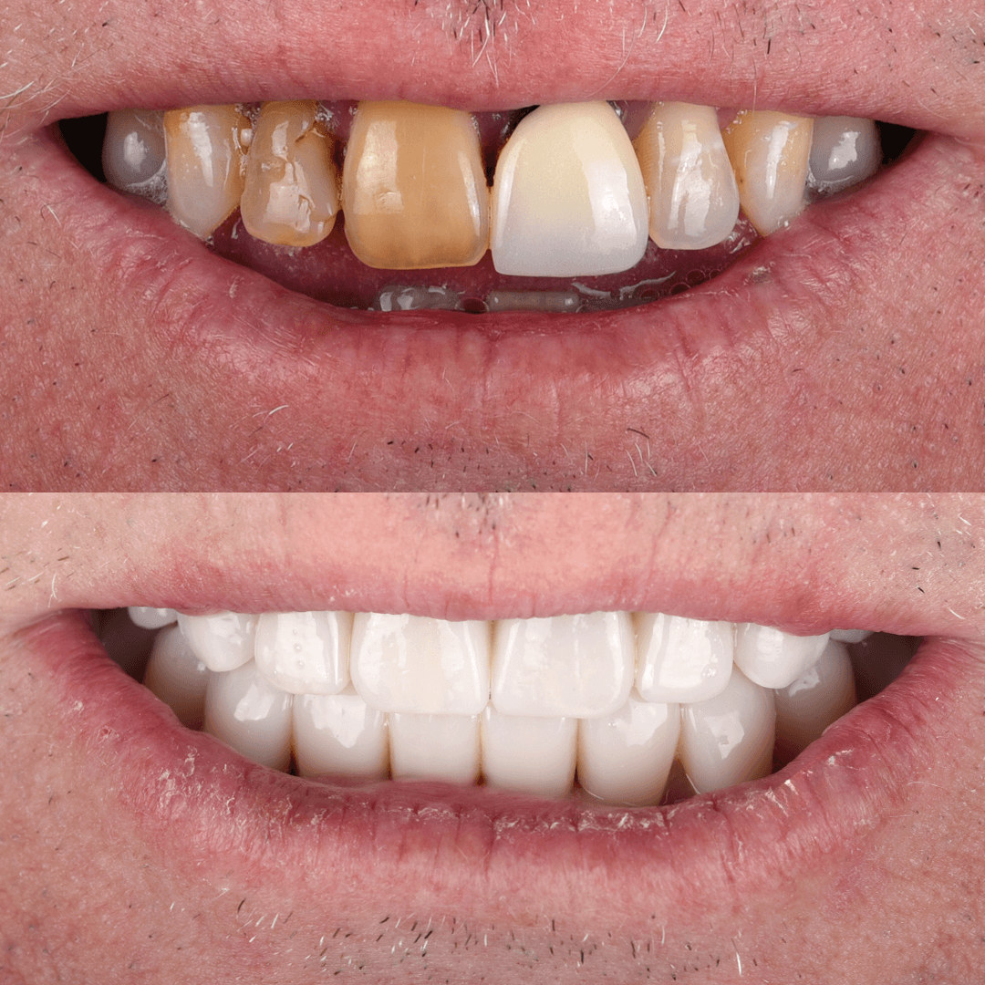 Crowns & Implants