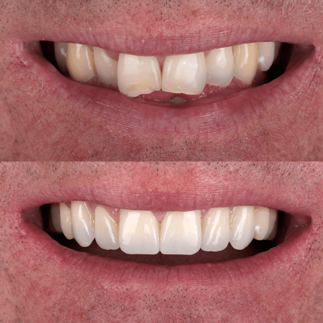 Crowns & Implants