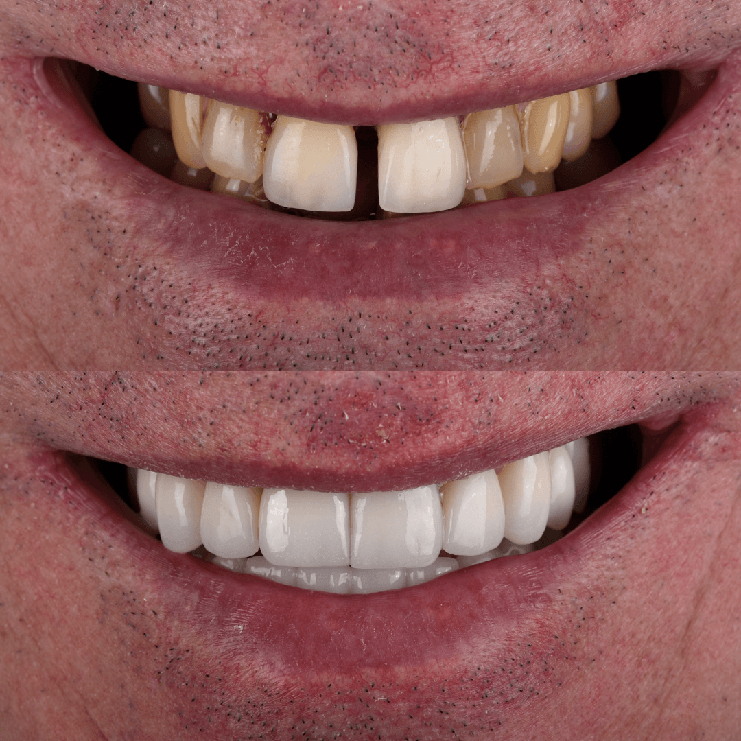Crowns & Implants