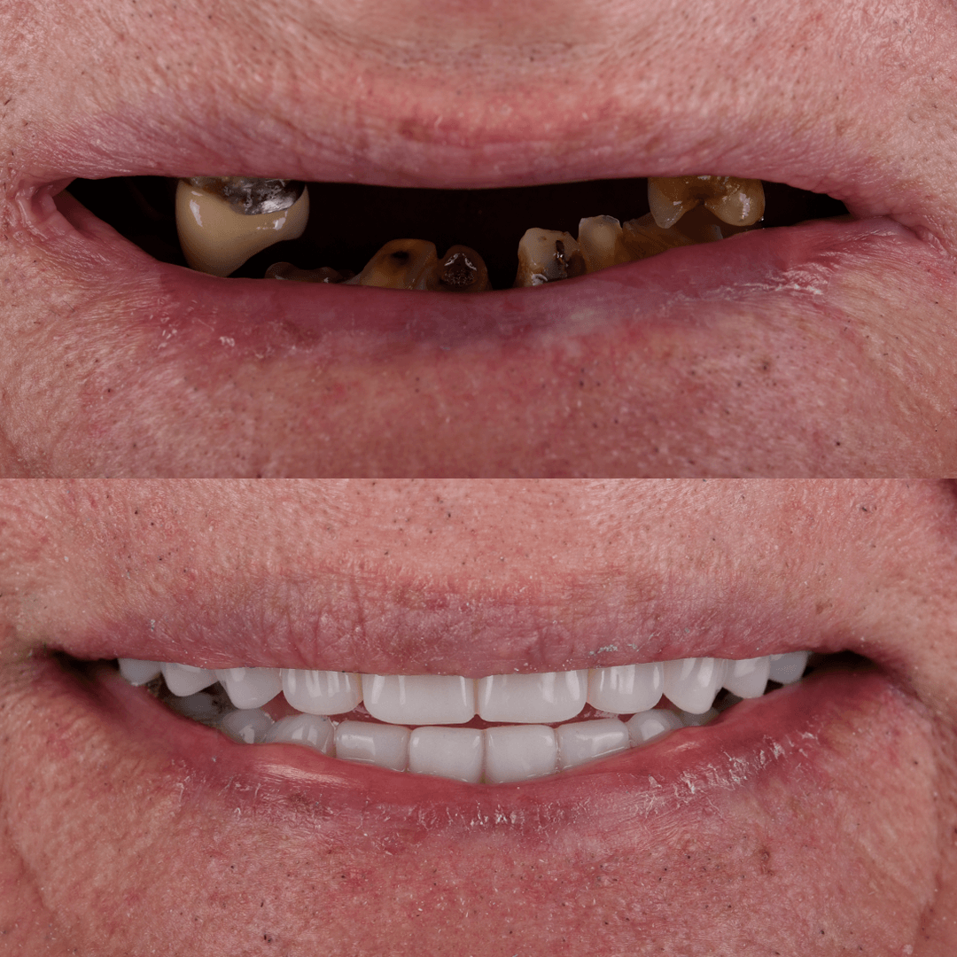 All-on-X Implant