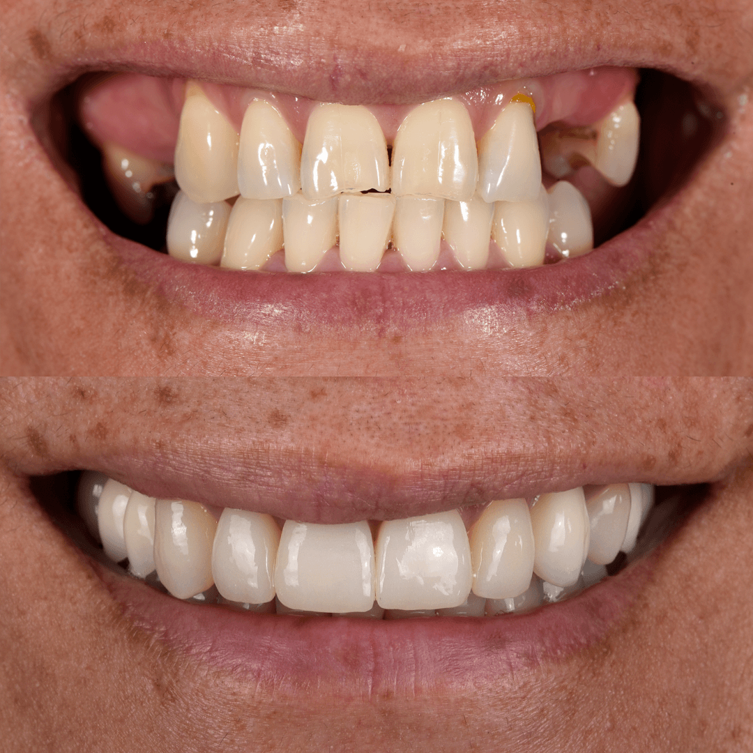 Crowns & Implants