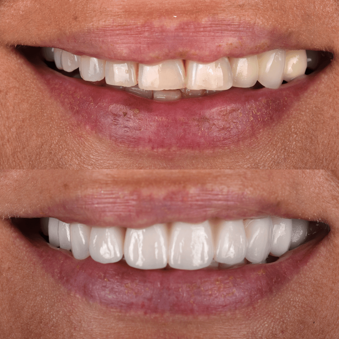 Crowns & Implants