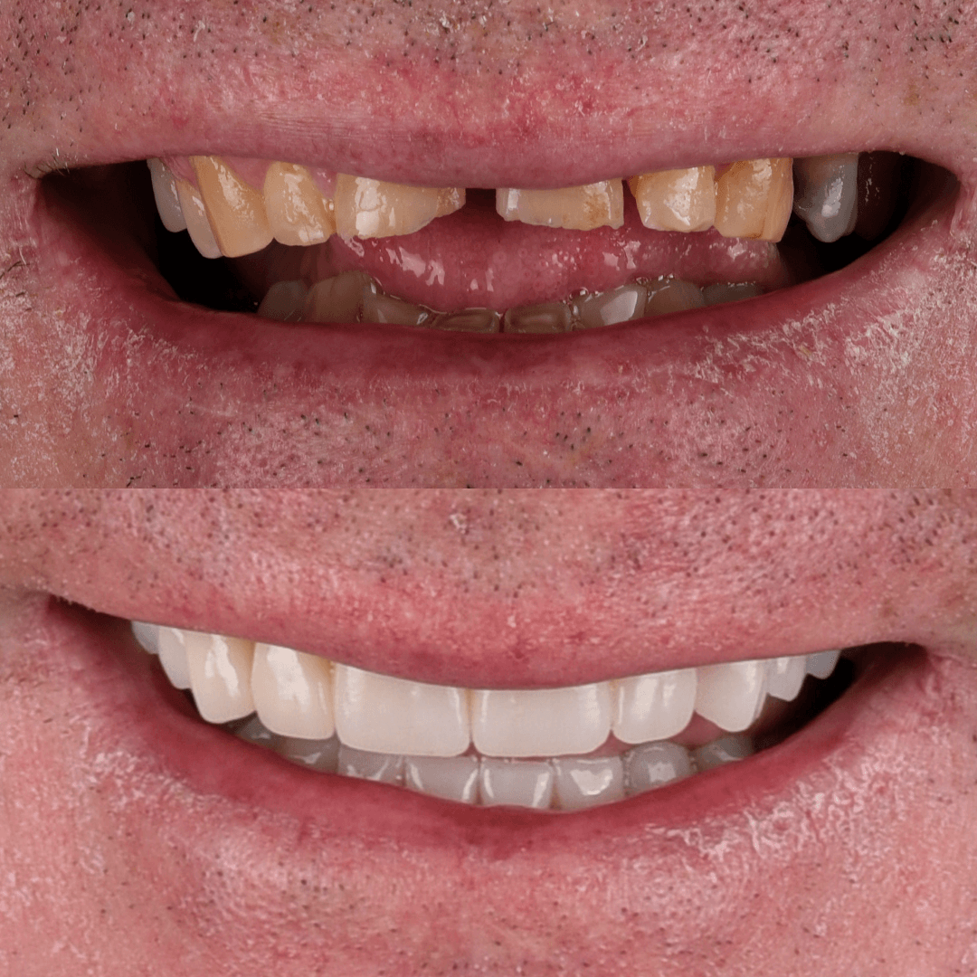 Crowns & Implants