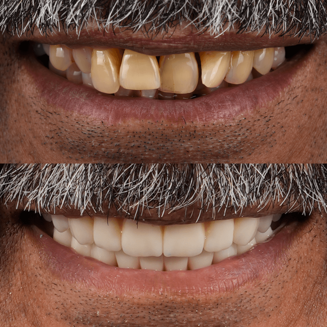 All-on-X Implant