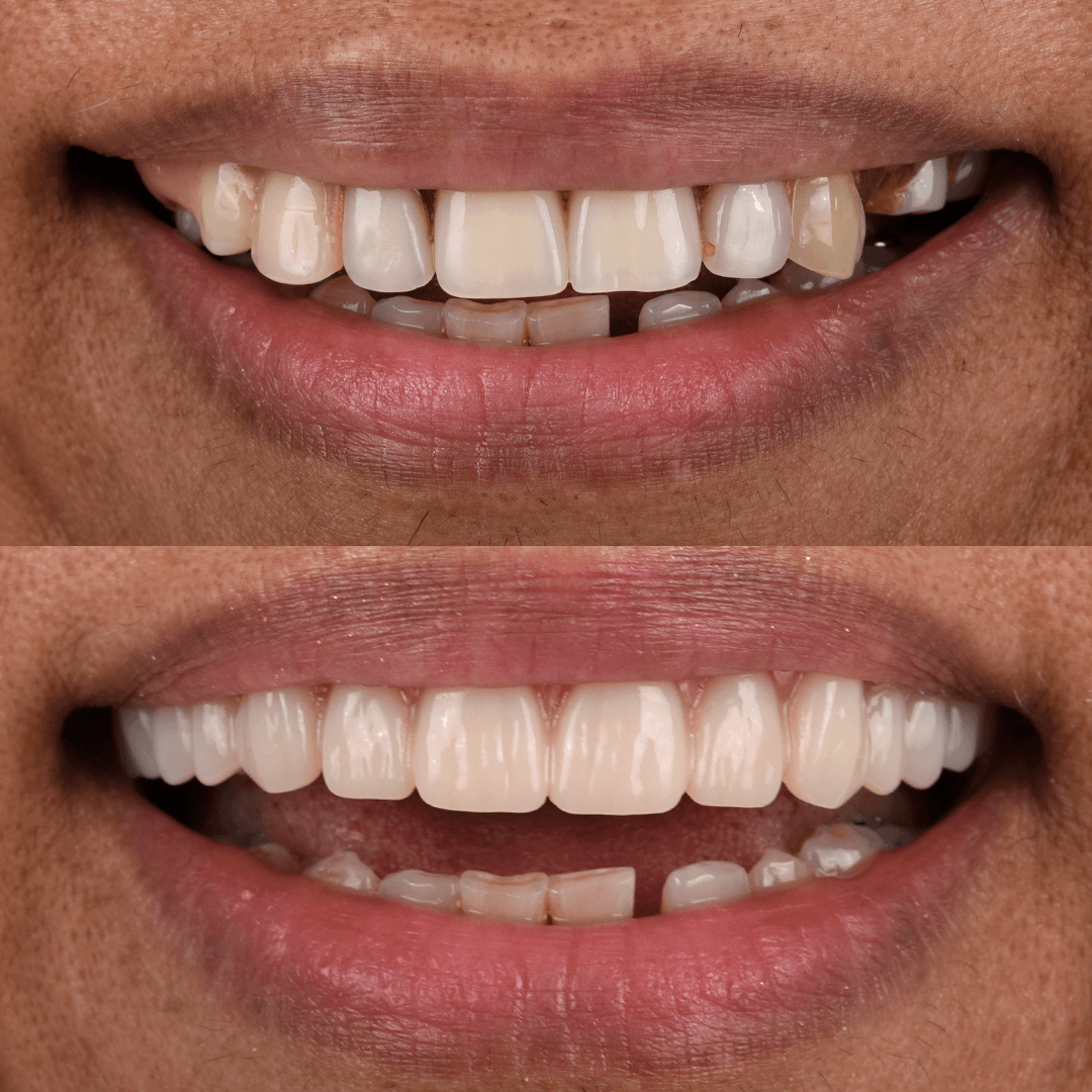All-on-X Implant