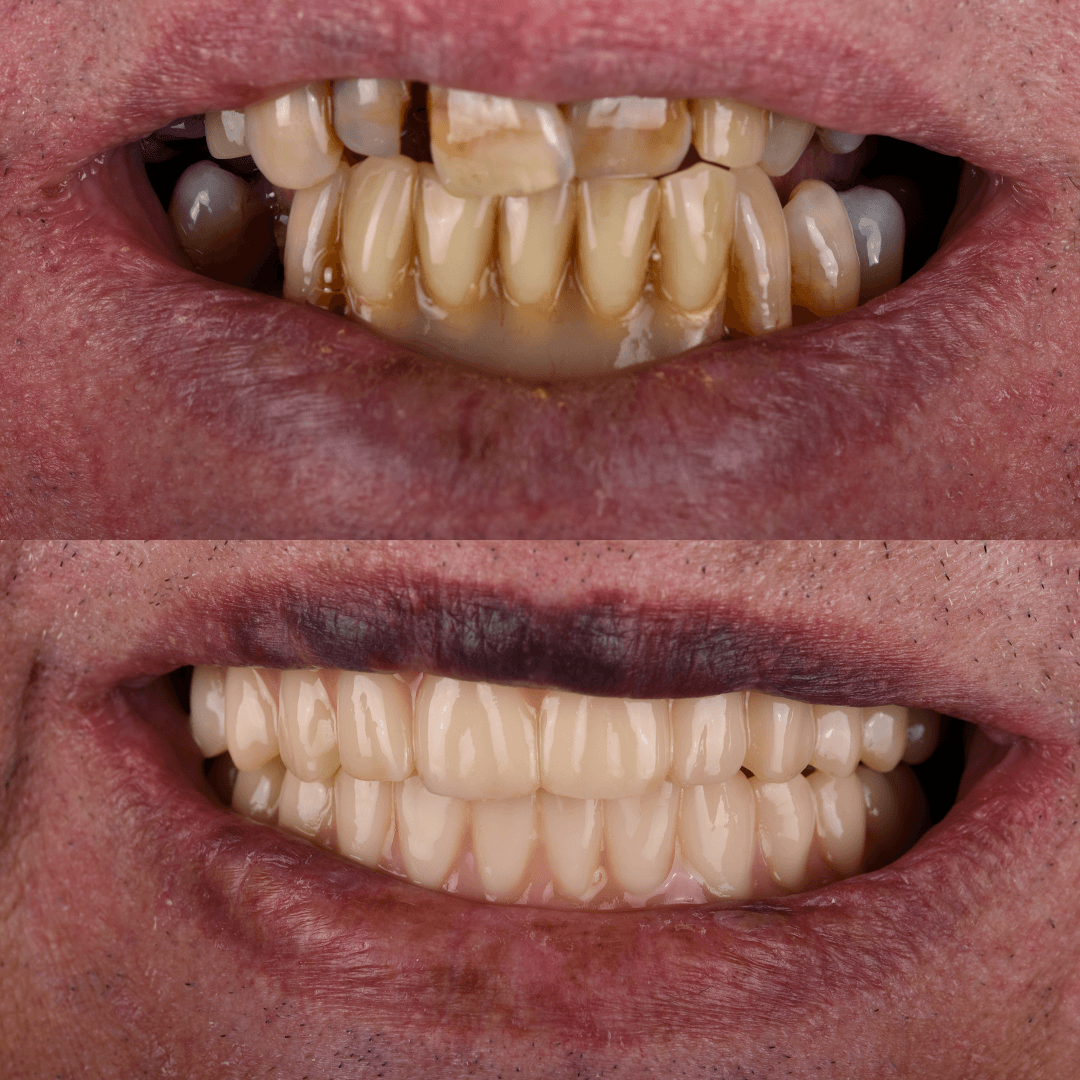 All-on-X Implant